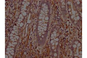 IHC image of ABIN7127784 diluted at 1:100 and staining in paraffin-embedded human colon cancer performed on a Leica BondTM system. (Recombinant PTPN1 antibody)