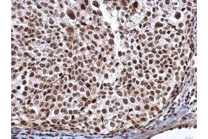 IHC-P Image ALY antibody detects ALY protein at nucleus in human cervical carcinoma by immunohistochemical analysis.