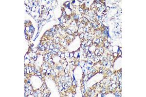 Immunohistochemistry of paraffin-embedded Human colon carcinoma using MRPS35 Rabbit pAb (ABIN7268587) at dilution of 1:100 (40x lens). (MRPS35 antibody  (AA 1-323))