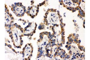 Anti- WASP Picoband antibody, IHC(P) IHC(P): Human Lung Cancer Tissue (WASP antibody  (C-Term))