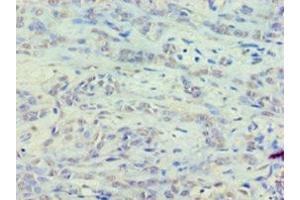 Immunohistochemistry of paraffin-embedded human breast cancer using ABIN7152122 at dilution of 1:100 (EEF1E1 antibody  (AA 2-174))
