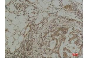 Immunohistochemical analysis of paraffin-embedded Human Breast Carcinoma using Pan Methylated Lysine Monoclonal Antibody. (Methylated Lysine antibody)
