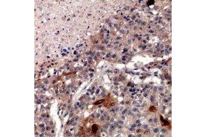 Immunohistochemical analysis of ZNT2 staining in human lung cancer formalin fixed paraffin embedded tissue section.