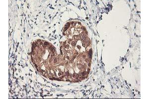 Immunohistochemical staining of paraffin-embedded Adenocarcinoma of Human breast tissue using anti-RBBP7 mouse monoclonal antibody. (RBBP7 antibody)