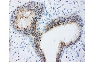 IHC-P: Bub3 antibody testing of human breast cancer tissue (BUB3 antibody  (Middle Region))