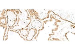 Immunohistochemistry of paraffin-embedded Human thyroid cancer tissue using RPP14 Polyclonal Antibody at dilution of 1:60(x200)