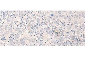Immunohistochemistry of paraffin-embedded Human cervical cancer tissue using THOP1 Polyclonal Antibody at dilution of 1:35(x200) (Thimet Oligopeptidase 1 antibody)