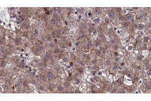 ABIN6273963 at 1/100 staining Human liver cancer tissue by IHC-P. (OR7E24 antibody)