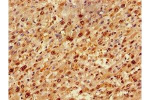 Immunohistochemistry of paraffin-embedded human liver cancer using ABIN7173917 at dilution of 1:100 (TP53INP1 antibody  (AA 138-205))