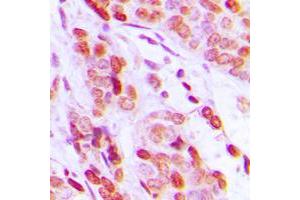 Immunohistochemical analysis of DAXX staining in human breast cancer formalin fixed paraffin embedded tissue section. (DAXX antibody  (C-Term))