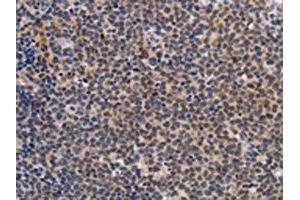 The image on the left is immunohistochemistry of paraffin-embedded Human Lymphoma tissue using ABIN7191963(POU4F1 Antibody) at dilution 1/25, on the right is treated with synthetic peptide. (POU4F1 antibody)