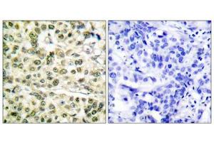 Immunohistochemical analysis of paraffin-embedded human breast carcinoma tissue, using PCNA antibody (ABIN5976487). (PCNA antibody  (Internal Region))