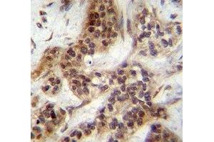FOXA2 antibody immunohistochemistry analysis in formalin fixed and paraffin embedded human bladder carcinoma. (FOXA2 antibody  (AA 134-163))