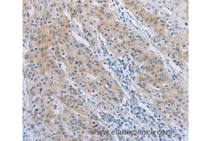 Immunohistochemistry of Human gastric cancer using AGAP2 Polyclonal Antibody at dilution of 1:30