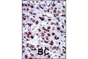 Formalin-fixed and paraffin-embedded human cancer tissue reacted with the primary antibody, which was peroxidase-conjugated to the secondary antibody, followed by AEC staining. (Adenylate Kinase 5 antibody  (N-Term))