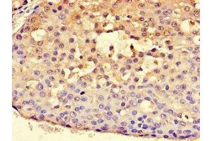 Immunohistochemistry of paraffin-embedded human breast cancer using ABIN7170815 at dilution of 1:100 (HSPA9 antibody  (AA 458-679))