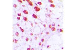 Immunohistochemical analysis of DNA Polymerase beta staining in human breast cancer formalin fixed paraffin embedded tissue section. (POLB antibody  (C-Term))