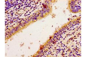 Immunohistochemistry of paraffin-embedded human lung cancer using ABIN7168176 at dilution of 1:100