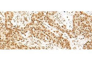 Immunohistochemistry of paraffin-embedded Human ovarian cancer tissue using NHP2 Polyclonal Antibody at dilution of 1:55(x200)