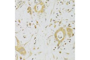 Immunohistochemistry of paraffin-embedded human liver cancer using CASP2 Antibody (ABIN2561574) at dilution of 1:100 (40x lens).