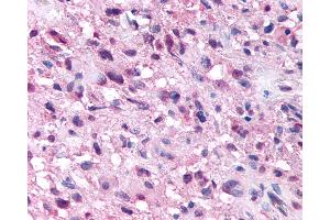 Anti-NPSR1 / NPSR / GPR154 antibody IHC of human Brain, Glioblastoma.
