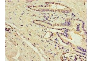 Immunohistochemistry of paraffin-embedded human prostate cancer using ABIN7143204 at dilution of 1:100