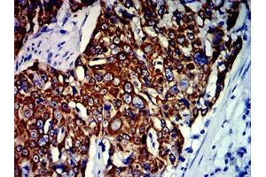 Immunohistochemical analysis of paraffin-embedded esophageal cancer tissues using KRT13 mouse mAb with DAB staining. (Cytokeratin 13 antibody  (AA 104-458))