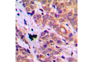 Immunohistochemical analysis of HSP27 staining in human breast cancer formalin fixed paraffin embedded tissue section.