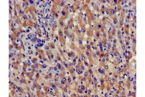 Immunohistochemistry of paraffin-embedded human liver cancer using ABIN7159025 at dilution of 1:100 (SPG21 antibody  (AA 1-308))