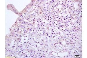 Formalin-fixed and paraffin embedded human gastric carcinoma labeled with Anti-phospho-E2F1(Ser364)Polyclonal Antibody, Unconjugated  at 1:200 followed by conjugation to the secondary antibody and DAB staining. (E2F1 antibody  (pSer364))