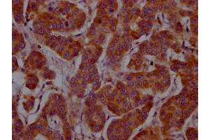 IHC image of ABIN7127570 diluted at 1:100 and staining in paraffin-embedded human breast cancer performed on a Leica BondTM system. (Recombinant IL-4 antibody)