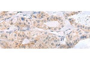 Immunohistochemistry of paraffin-embedded Human thyroid cancer tissue using PHLDA3 Polyclonal Antibody at dilution of 1:110(x200) (PHLDA3 antibody)