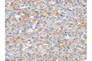 The image on the left is immunohistochemistry of paraffin-embedded Human liver cancer tissue using ABIN7192585(SNX25 Antibody) at dilution 1/35, on the right is treated with synthetic peptide. (SNX25 antibody)