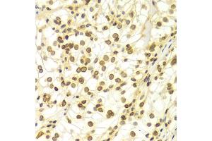 Immunohistochemistry of paraffin-embedded Human kidney cancer using Lamin A/C antibody (ABIN5970079) at dilution of 1/100 (40x lens). (Lamin A/C antibody)