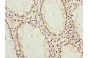 Immunohistochemistry of paraffin-embedded human colon cancer using ABIN7145189 at dilution of 1:100 (B9D2 antibody  (AA 1-175))