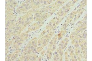 Immunohistochemistry of paraffin-embedded human liver cancer using ABIN7159907 at dilution of 1:100 (TIMM8A/DDP antibody  (AA 1-97))