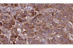 ABIN6273841 at 1/100 staining Human liver cancer tissue by IHC-P. (CCR2 antibody  (Internal Region))