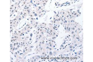 Immunohistochemistry of Human lung cancer using POMC Polyclonal Antibody at dilution of 1:30
