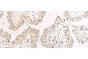 Immunohistochemistry of paraffin-embedded Human liver cancer tissue using HASPIN Polyclonal Antibody at dilution of 1:45(x200) (GSG2 antibody)