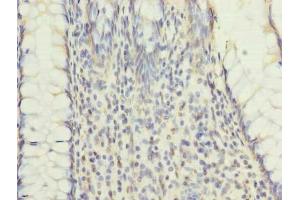 Immunohistochemistry of paraffin-embedded human colon cancer using ABIN7151184 at dilution of 1:100 (RNF26 antibody  (AA 246-433))