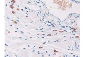 Detection of CEACAM7 in Human Colorectal cancer Tissue using Polyclonal Antibody to Carcinoembryonic Antigen Related Cell Adhesion Molecule 7 (CEACAM7) (CEACAM7 antibody  (AA 147-231))