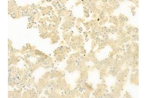 ABIN6259921 and ABIN6277899 at 1/100 staining human melanoma by IHC-P. (Amylin/DAP antibody  (Internal Region))