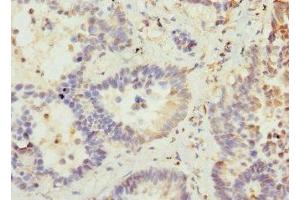 Immunohistochemistry of paraffin-embedded human lung cancer using ABIN7175358 at dilution of 1:100 (VANGL2 antibody  (AA 1-110))