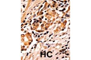 Formalin-fixed and paraffin-embedded human hepatocellular carcinoma tissue reacted with BAD (phospho S75) polyclonal antibody  which was peroxidase-conjugated to the secondary antibody followed by AEC staining.