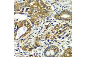 Immunohistochemistry of paraffin-embedded human gastric cancer using CDC16 antibody  at dilution of 1:100 (40x lens). (CDC16 antibody  (AA 371-620))
