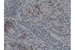 IHC-P analysis of Human Skin Cancer Tissue, with DAB staining. (Angiotensin I Converting Enzyme 1 antibody  (AA 1160-1306))