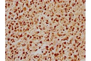 IHC image of ABIN7153409 diluted at 1:200 and staining in paraffin-embedded human glioma performed on a Leica BondTM system. (GABPA antibody  (AA 268-372))