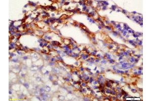 Formalin-fixed and paraffin embedded human lung carcinoma labeled with Anti-TMEM49 Polyclonal Antibody, Unconjugated  at 1:200 followed by conjugation to the secondary antibody and DAB staining (VMP1 antibody  (AA 361-406))