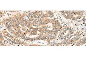 Immunohistochemistry of paraffin-embedded Human liver cancer tissue using CPNE4 Polyclonal Antibody at dilution of 1:40(x200) (Copine IV antibody)