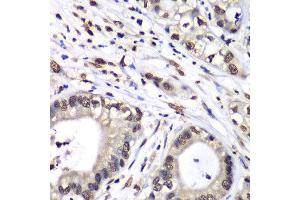 Immunohistochemistry of paraffin-embedded human liver cancer using HNRNPM antibody at dilution of 1:100 (x40 lens).
